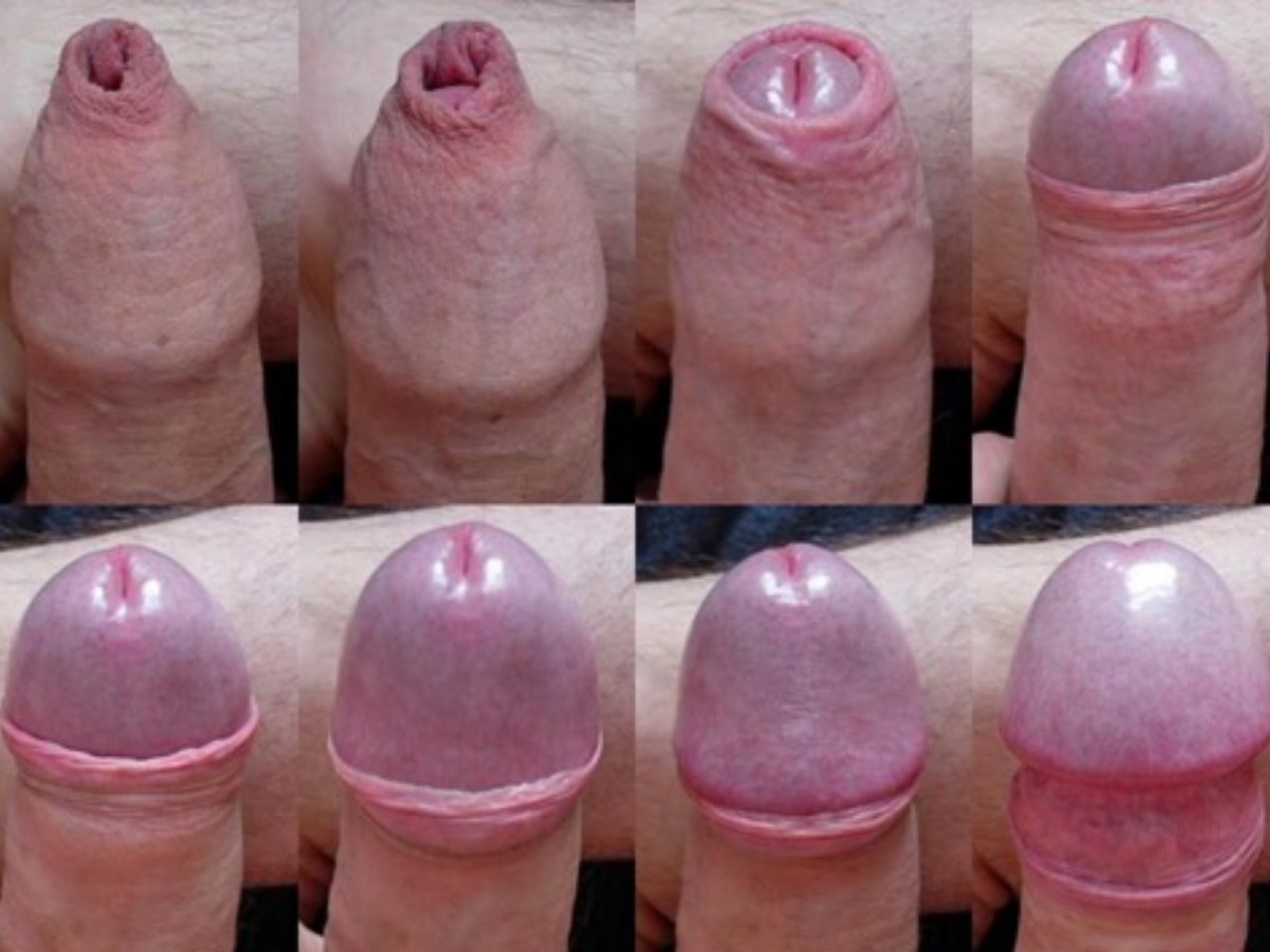 Foreskin Retraction