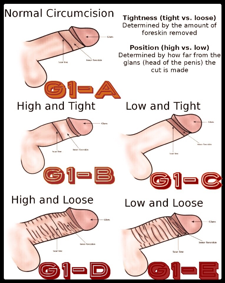 Penile Classification Worksheet